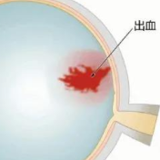 眼前有黑影就是飞蚊症？47岁阿姨被确诊为玻璃体积血