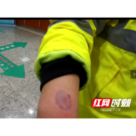 男子酒驾被查撕咬警察 “袭警入刑”后衡阳侦办首起袭警案件