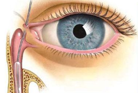 泪囊炎能自愈？75岁大爷急性发作，眼角鼓包流脓