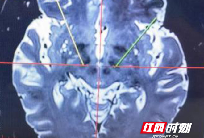 首例DBS手术成功开展，南华医院帕金森病诊疗开启新篇章