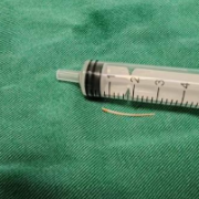 鱼刺卡喉两个月多次就医无解 衡阳市中心医院耳鼻喉头颈外科精准拔出