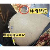 七旬老人肚如九月孕妇，南华医院多学科联动诊治解难题