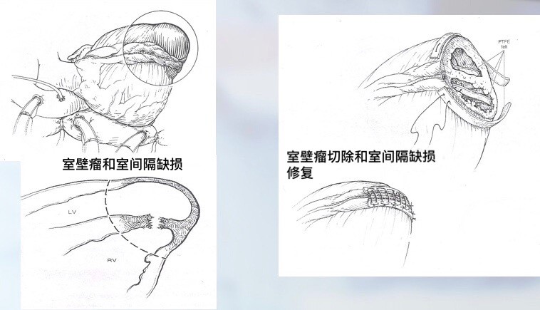 室壁瘤图解图片