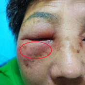 眼睛总流泪是月子后遗症？58岁阿姨被诊断为急性泪囊炎