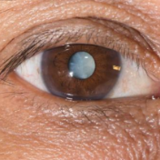 白内障手术做晚了会有什么后果？