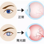 青光眼患者运动时应注意什么？