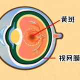 棋盘看上去歪歪扭扭？58岁大爷患上这种致盲眼病