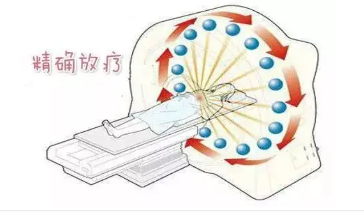 六旬老人脑转移瘤致瘫痪 南华医院精准放疗助行走