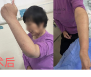 永州市中心医院独立完成肘关节置换术