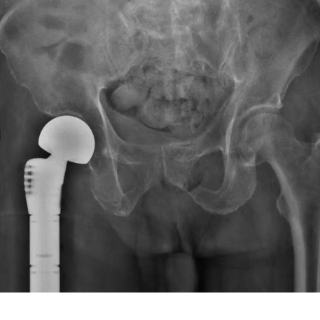 医疗服务提升年丨永州中心医院成功为八旬骨肿瘤患者实施髋关节置换术