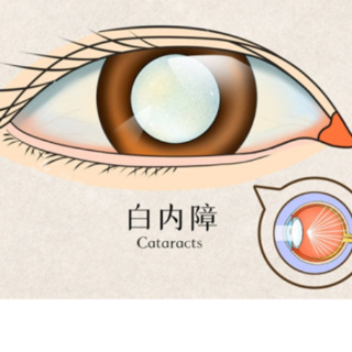 永医科普丨白内障患者的视力救赎指南