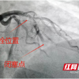 益阳：长期“熬夜＋抽烟”，90后小伙突发心梗险丧命