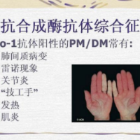什么是抗合成酶综合征?医生提醒:出现这些症状需警惕