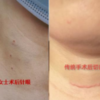 “以针代刀”微波消融术 精准消除甲状腺结节