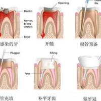 牙痛的“绝密武器”——根管治疗