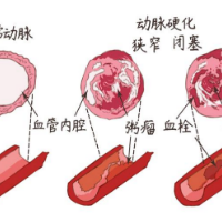 心脑血管病2周就缓解！医生提醒：疏通是关键