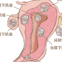 “拆弹”专家上线！妊娠合并子宫肌瘤 一场母婴保卫战正在打响