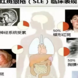 世界狼疮日 | 无需谈“狼”色变 专家带你了解