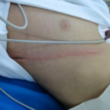 “密室逃脱”意外受伤 10岁男孩大脑缺氧险酿严重后果