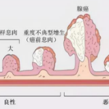 科普 | 肠息肉切除就完事？医生提醒：警惕术后并发症