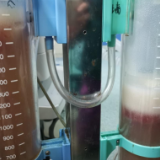 13岁女孩腹部增大以为是“长胖” 检查发现巨大卵巢肿瘤