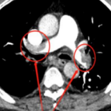 每日搓4小时麻将 长沙爹爹肺部多处栓塞