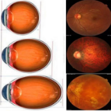 “近视眼”看过来:这些近视并发症可致盲!