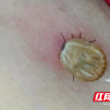 野外游玩要当心 被蜱虫叮咬后不能乱拔