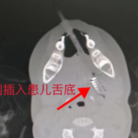 揪心！3岁女孩刷牙时不慎摔倒，牙刷插入舌底……