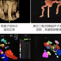妇科诊疗的“火眼金睛”——子宫三维成像