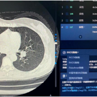 科普 | 胸部低剂量CT：肺结节筛查首选利器