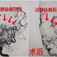 8个小时解决“头等大事” “一站式”精准拆除脑部多颗“炸弹”