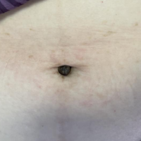 抠肚脐烂肠子? 医生:长期不清洁警惕皮脂腺囊肿