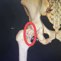 关节里长“珍珠”？关节疼痛小心这种病