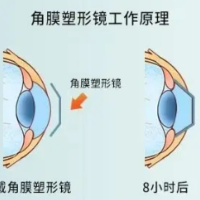 孩子近视，选好选对防控眼镜很关键！