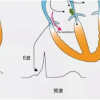 花季少年的“心病” 竟因心脏不走“寻常路”