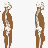 背太直，胸就闷？警惕直背综合征
