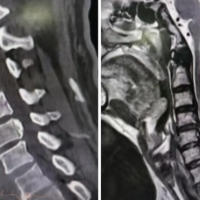 肢体麻木、行走不稳……警惕脊髓型颈椎病