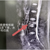 胸腰椎压缩性骨折如何保守治疗？