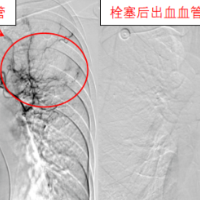 咯血莫慌张，微创介入来帮忙