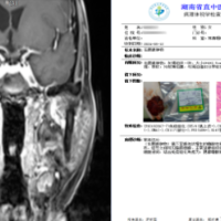 “腮帮子肿了”是怎么回事？医生揭秘您不知道的腮腺疾病