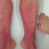 长沙爹爹普通感冒后“红了”！医生提醒：安全用药无小事