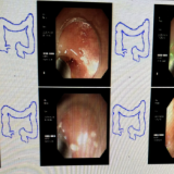 8岁娃突发阑尾炎,开刀还是保守?这项ERAT技术实现“无疤治愈”