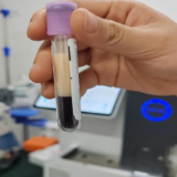 男子检查抽出“奶油血”，竟是甘油三酯超标四十多倍！专家提醒应这样预防