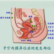 【健康科普】经期腹痛 小心腹壁子宫内膜异位症