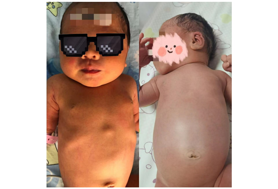 健康科普|新生儿黄疸巧识别，宝爸宝妈不用慌