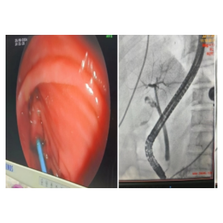 怀化市第二人民医院：ERCP技术成功救治一名重症胆源性胰腺炎患者