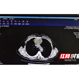 邵阳市中心医院完成又一例高难度剑突下胸腔镜纵膈肿瘤切除术