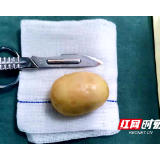 隆回：患者腹痛突发“肠梗阻”，腹内取出“黄宝石”