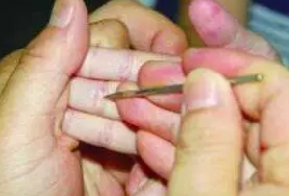 发烧了扎手指放血可降温？ 专家：居家蛮干易感染